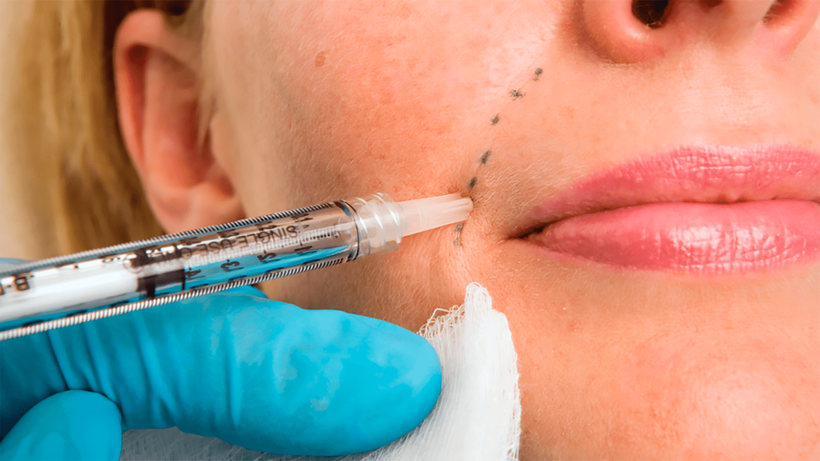 Les avantages et les inconvénients des différentes techniques d'injection de filler